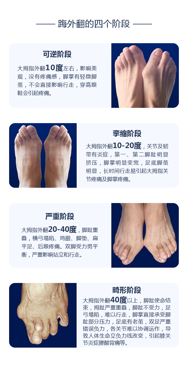 踇外翻的四个阶段