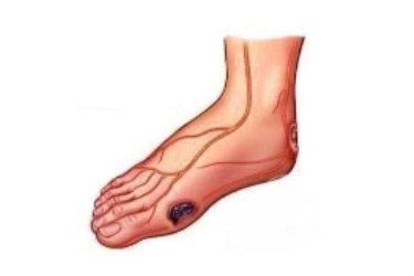 糖尿病足早期治疗