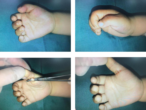 小二腱鞘炎-sararz手外科