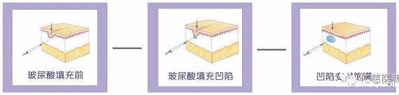 进口玻尿酸全脸填充
