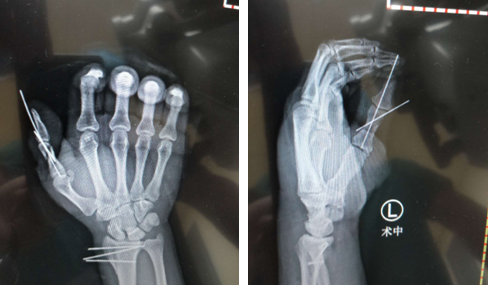 betway在线登陆手外科