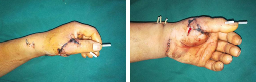 betway在线登陆手外科