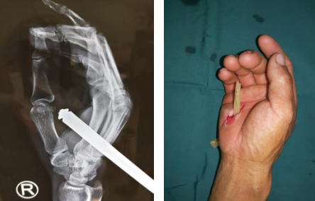 betway在线登陆手外科