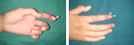 betway在线登陆手外科