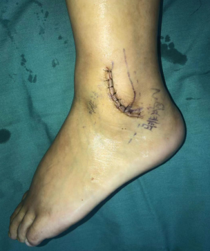 betway在线登陆足踝