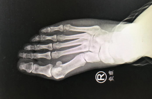 betway在线登陆足踝