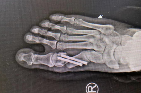 betway在线登陆足踝