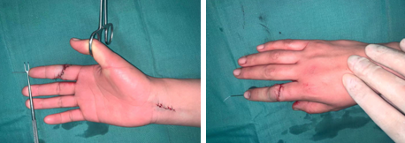 betway在线登陆手外科