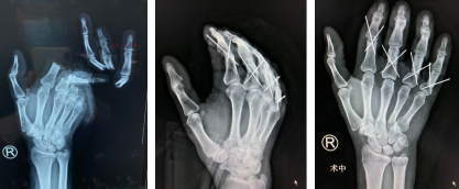 betway在线登陆手外科