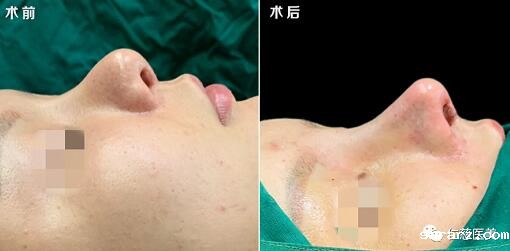 鼻综合