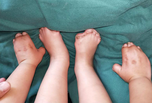 <a href='http://www.sararz.com/' target='_blank'><u>betway在线登陆</u></a>手指畸形