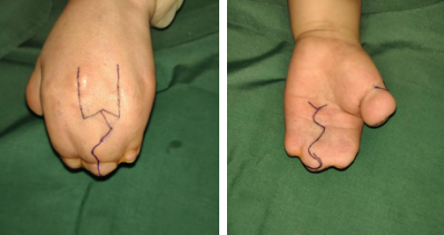 betway在线登陆手指畸形