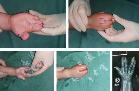 betway在线登陆手指畸形