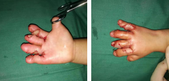 betway在线登陆手指畸形