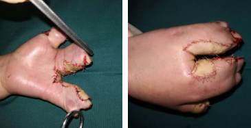 betway在线登陆手指畸形