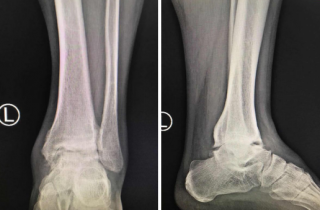 【踝关节镜】关节镜下全踝融合，sararz足踝两个小孔解决中年男子多年