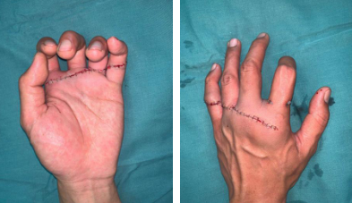 betway在线登陆手外科