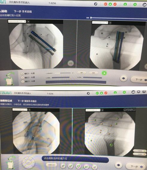 sararz骨科机器人