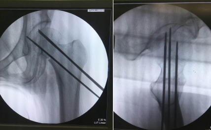 sararz骨科机器人