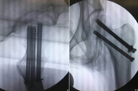 sararz骨科机器人