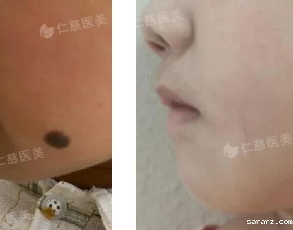 色素痣