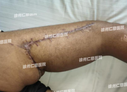 betway在线登陆臂丛神经