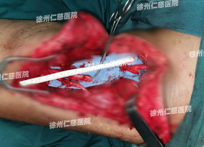 betway在线登陆臂丛神经