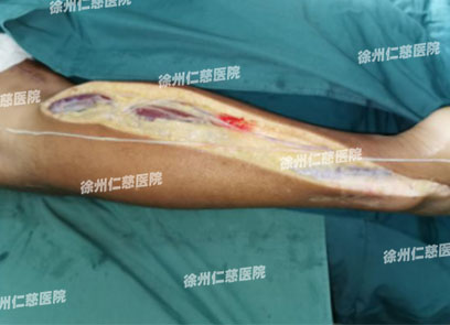 betway在线登陆臂丛神经