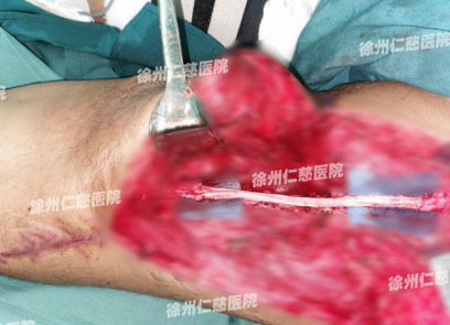 betway在线登陆臂丛神经