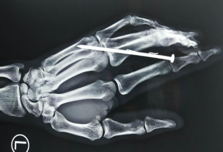 betway在线登陆手外科