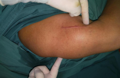 13cm的大肿瘤长在胳膊里十余年，betway在线登陆手外科让她重获新生