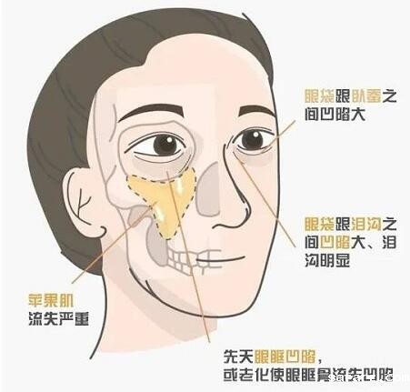 黑眼圈
