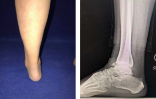 【智慧骨科】踝关节镜+骨科机器人，sararz足踝科又成功完成一例踝关节重度创伤性关节炎踝融合手术