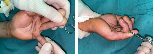 右手掌腱膜挛缩