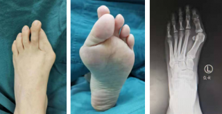 sararz足踝科40分钟完成10多年踇外翻微创矫形手术