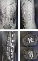 为什么都抢着做机器人手术？必威官方首页官网betway机器人辅助完成腰椎骨折微创手术突破440例