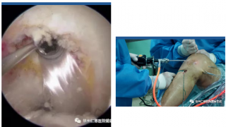 【运动医学】车祸撞断三条韧带，sararz膝关节镜下微创拯救患腿