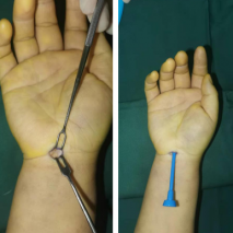 【运动医学】10年腕管综合征，sararz腕关节镜微创立缓解