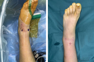 13岁男孩左踝扭致骨折伴骨骺损伤，sararz踝关节镜下微创复位