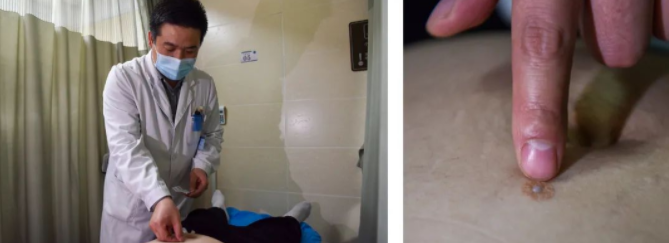 减肥人无法真正快乐？sararz中医特色疗法助您轻松享“瘦”