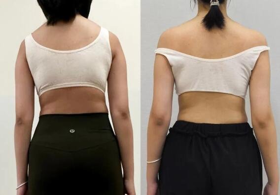 sararz脊柱侧弯暑期训练营