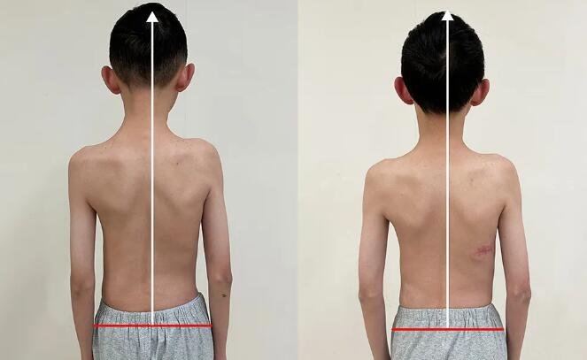 sararz脊柱侧弯暑期训练营