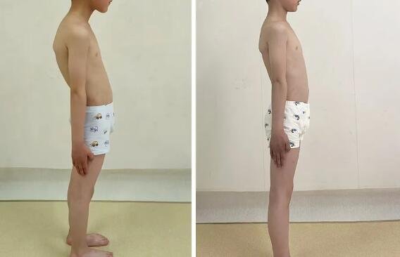 sararz脊柱侧弯暑期训练营