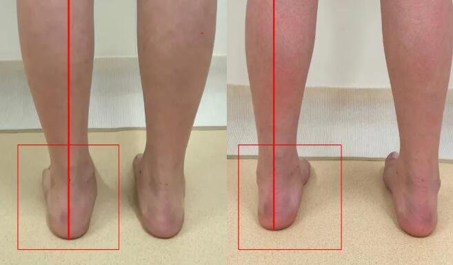 sararz脊柱侧弯暑期训练营