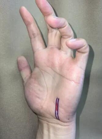 骑行60公里，她“累”到捏不起筷子 | 这是神经损伤，可能需手术！