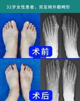 betway在线登陆拇外翻