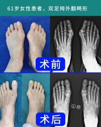 betway在线登陆拇外翻